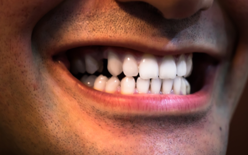 understanding gum disease