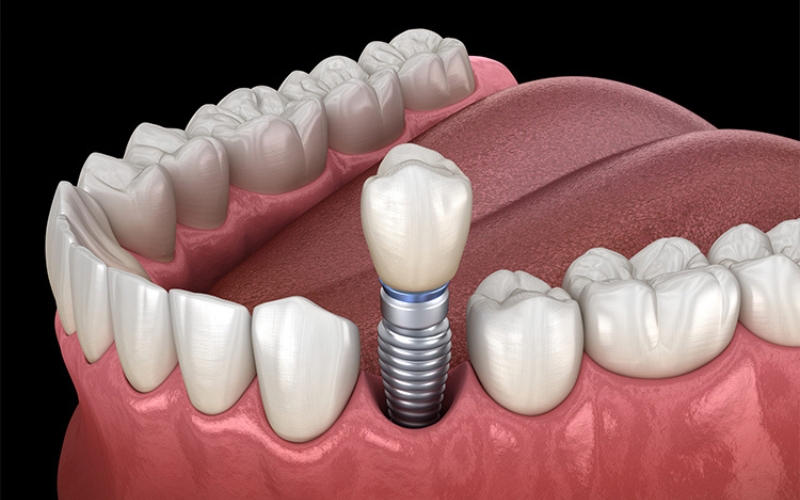 dental implants and cancer