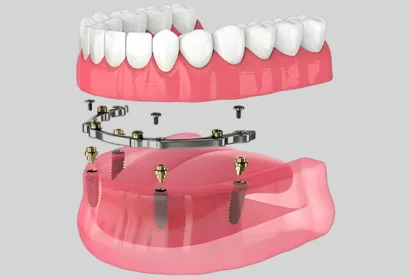 Implant Supported Dentures -  Stadium Family Dentistry