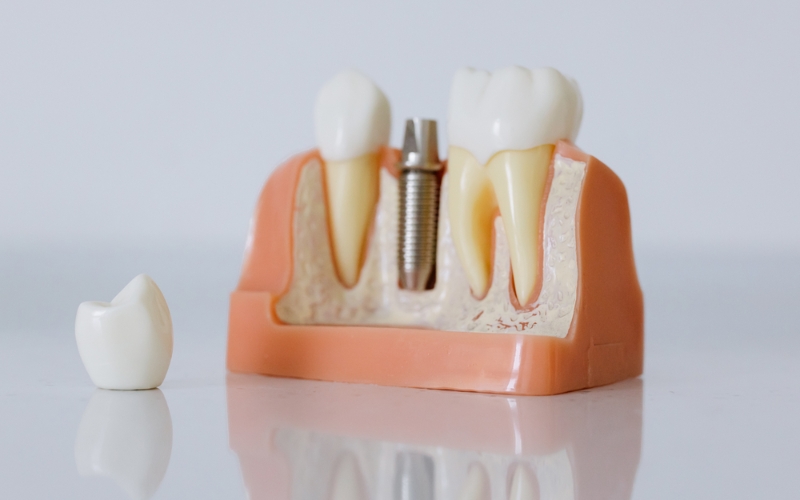 dental implant recovery process