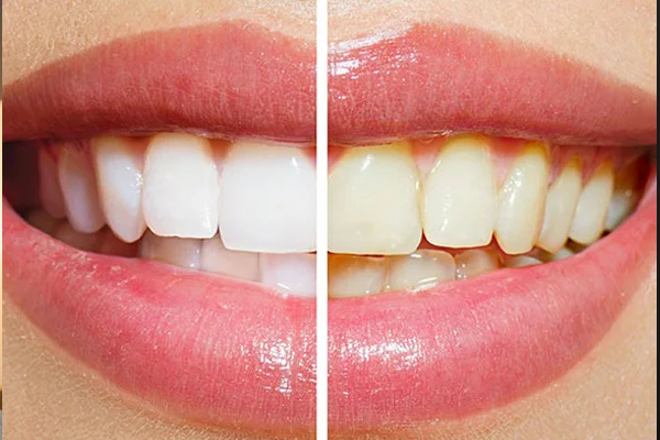 teeth whitening before and after