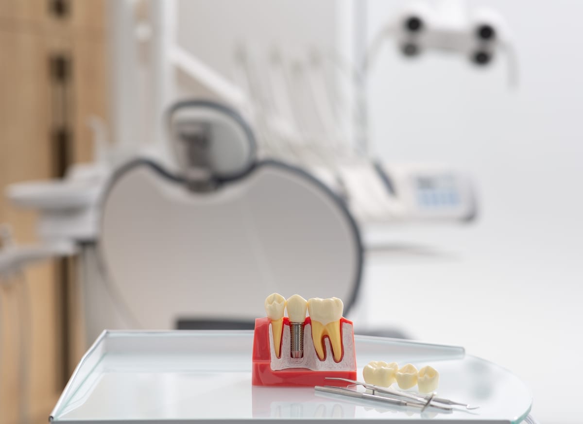 Dental Implants in Ann Arbor