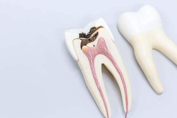Ask a General Dentist: Is a Tooth Dead After a Root Canal from Stadium Family Dentistry of Ann Arbor in Ann Arbor, MI