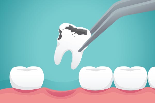 Ask a General Dentist: What Happens to Your Tooth After Extraction from Stadium Family Dentistry of Ann Arbor in Ann Arbor, MI