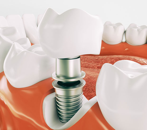 Ann Arbor Dental Implant Restoration